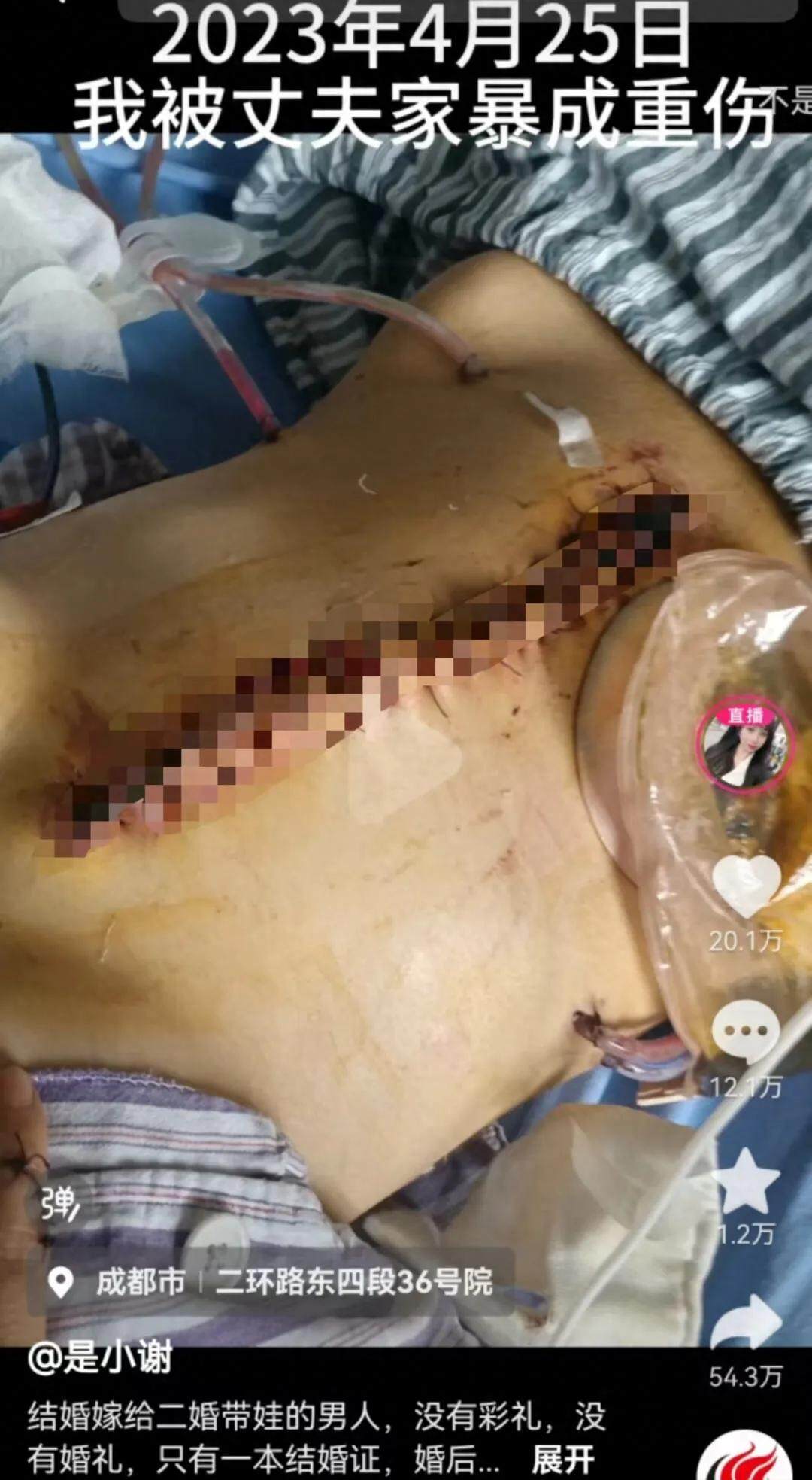 谢女士伤口。图/当事人社交媒体 谢女士伤口。图/当事人社交媒体