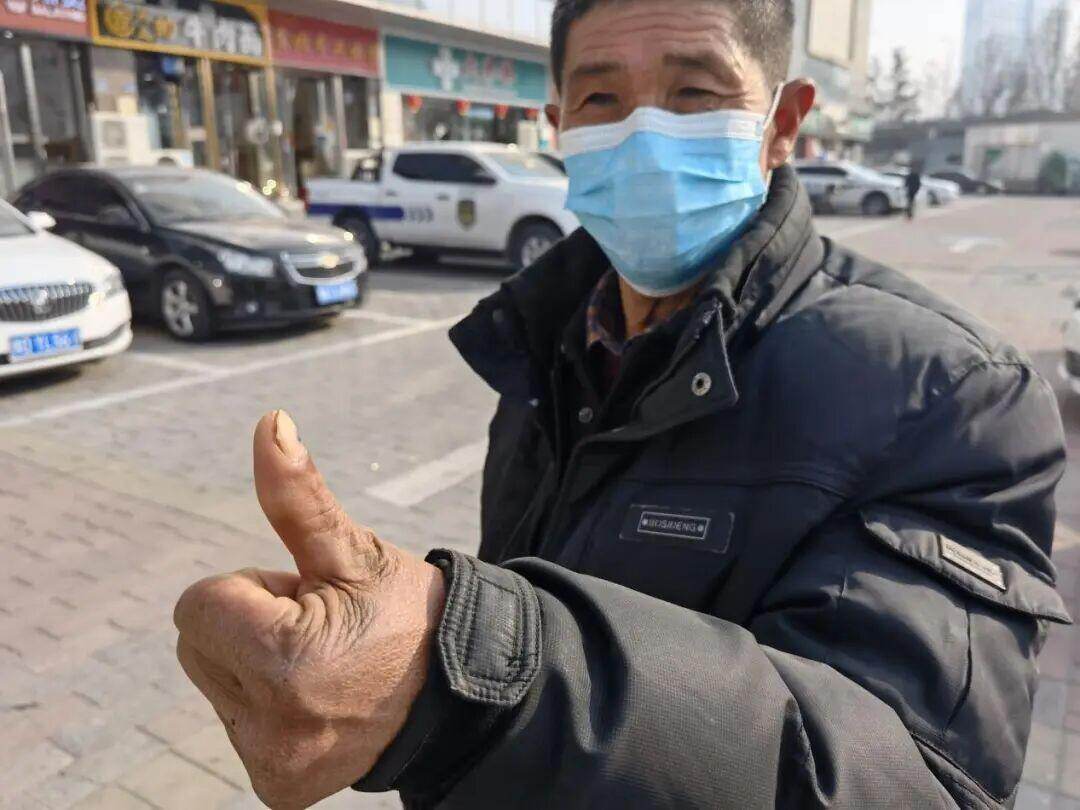 ▲患者王海森左手拇指关节以上部位被电锯切断，收费单显示术中使用了微血管吻合装置，但X光片中未显示该器械。新京报记者 程亚龙 摄