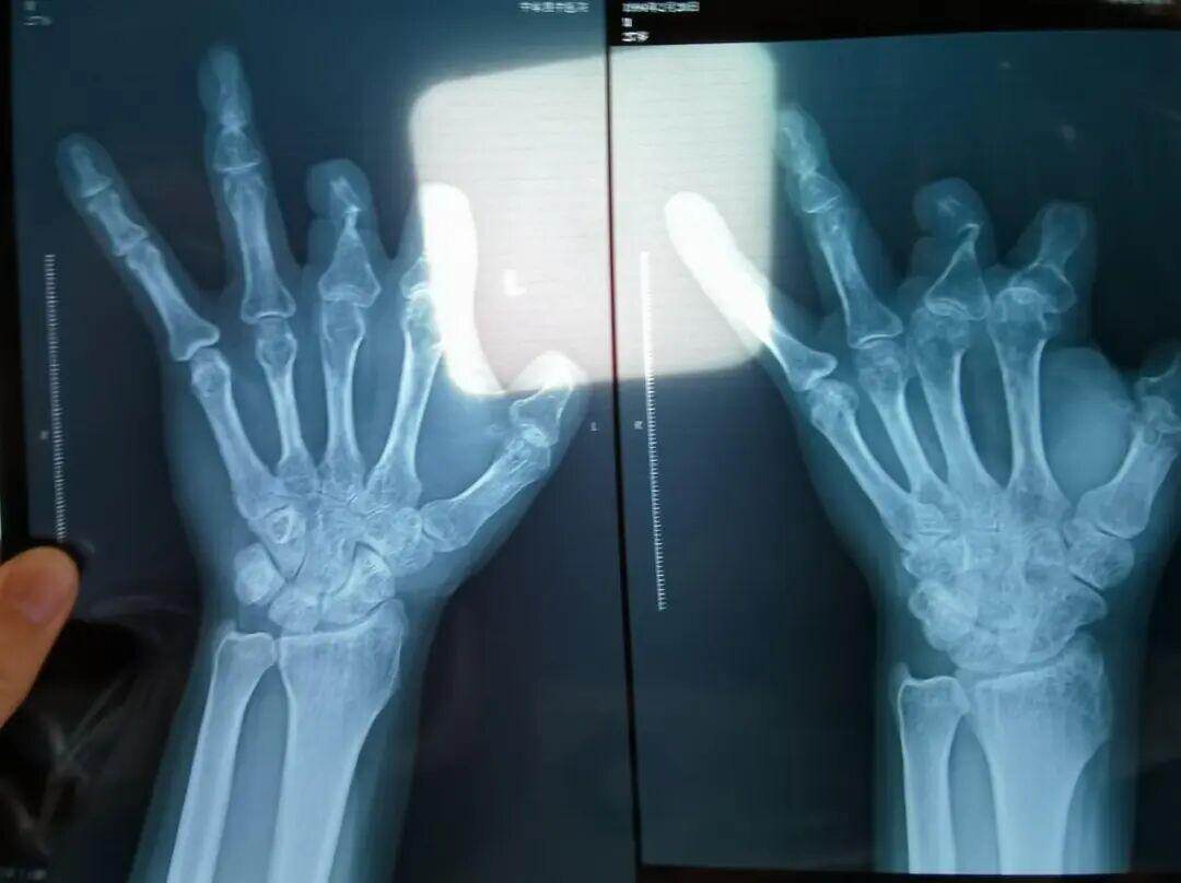 ▲2021年12月，患者彭先生拍摄的左手X光片，未见收费单据中列出的微血管吻合装置。新京报记者 程亚龙 摄