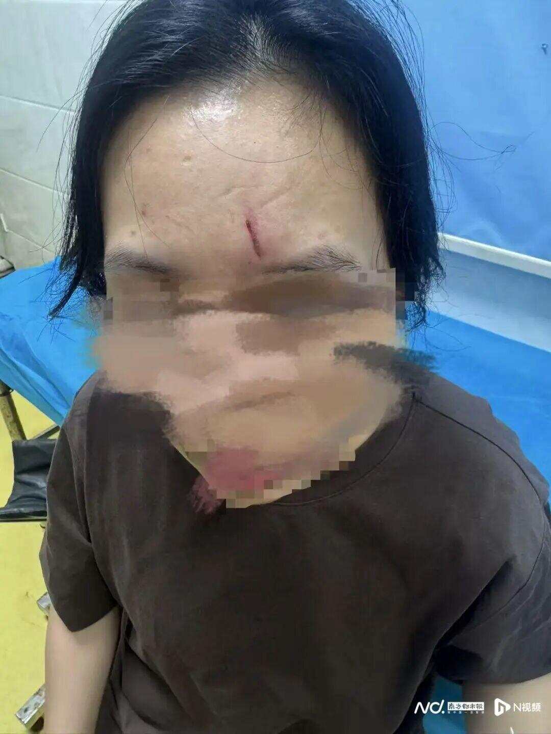 陈女士额头出现一道明显伤痕